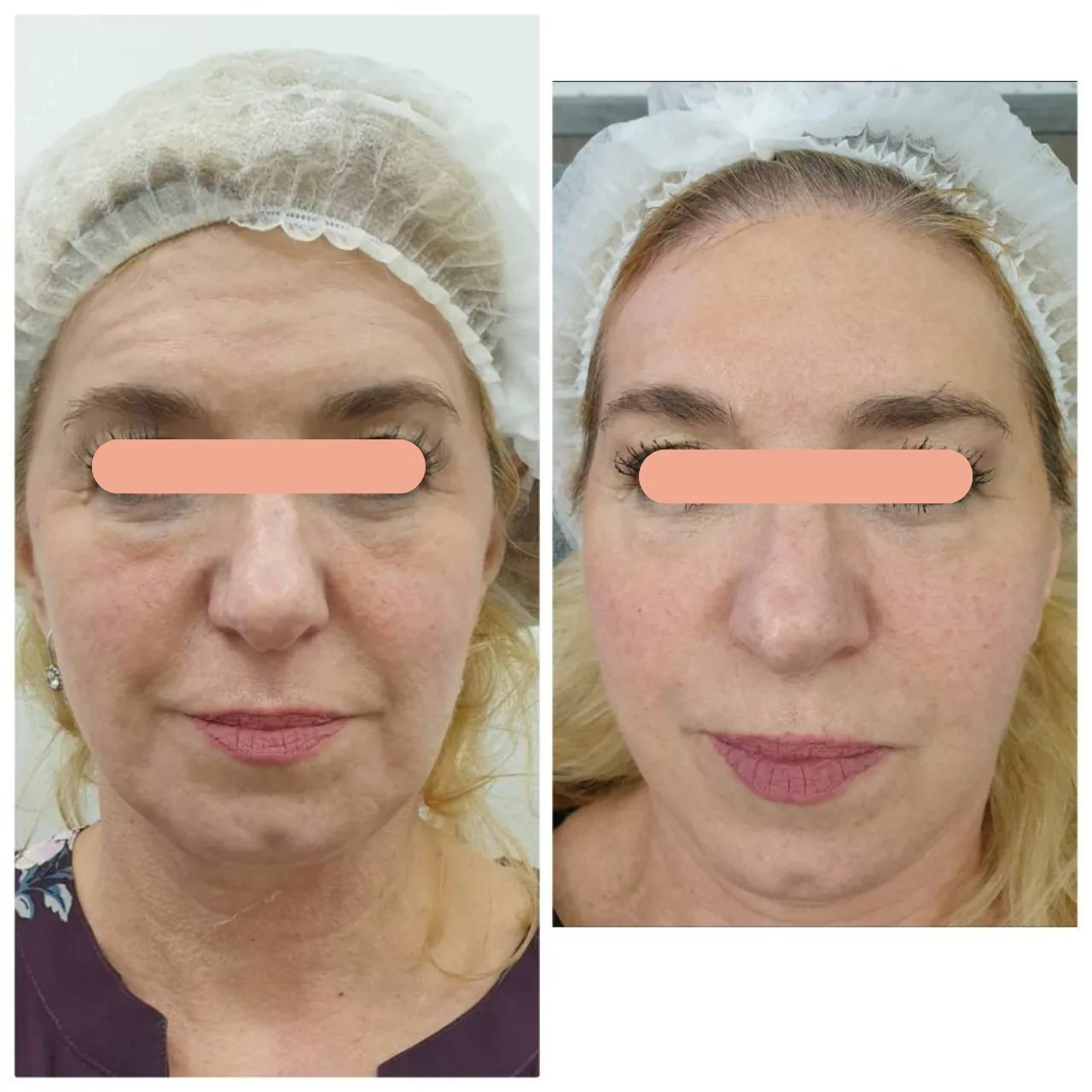 Face Lifting, Metatox Program, Filler and Thread Lift Programs