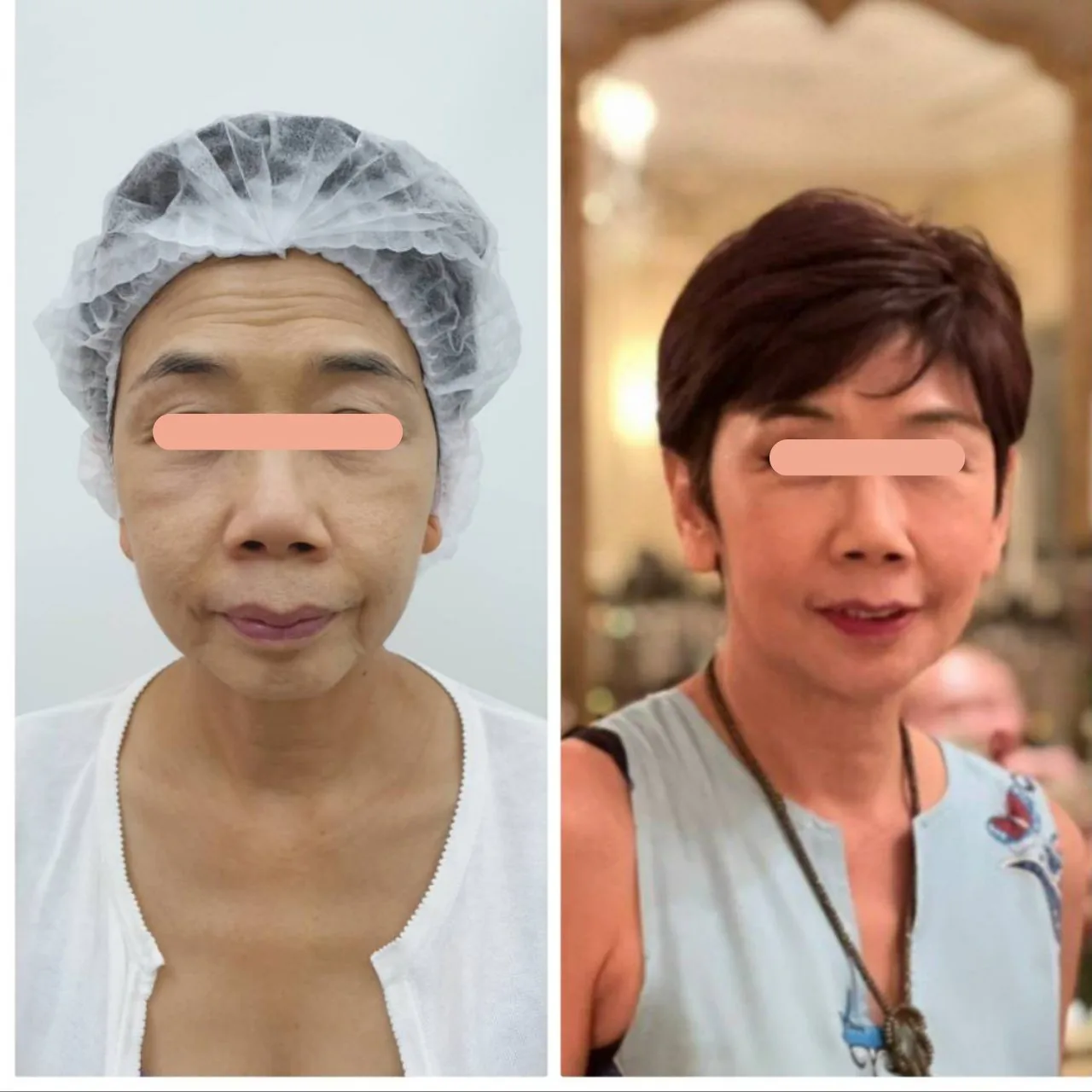Face Lifting, Metatox Program, Filler and Thread Lift Programs