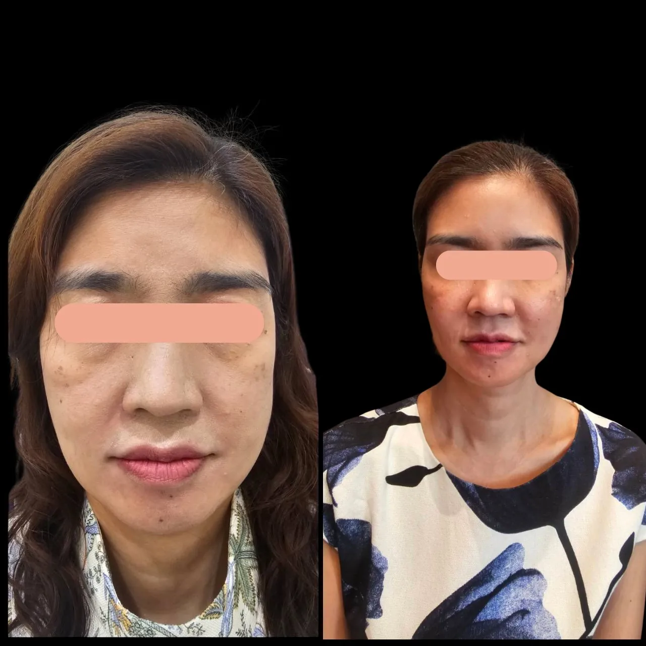Face Lifting, Metatox Program, Filler and Thread Lift Programs