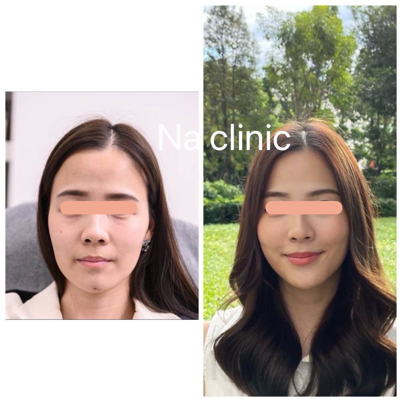 Face Lifting, Chin and Temple Filler