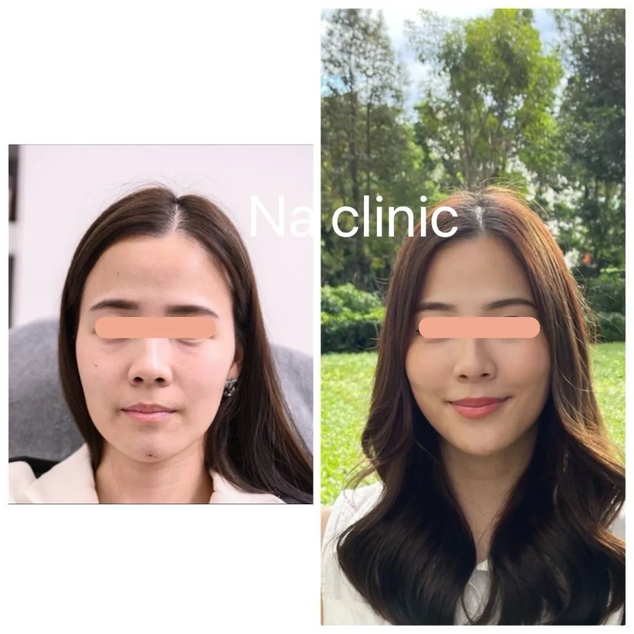 Face Lifting, Chin and Temple Filler Program