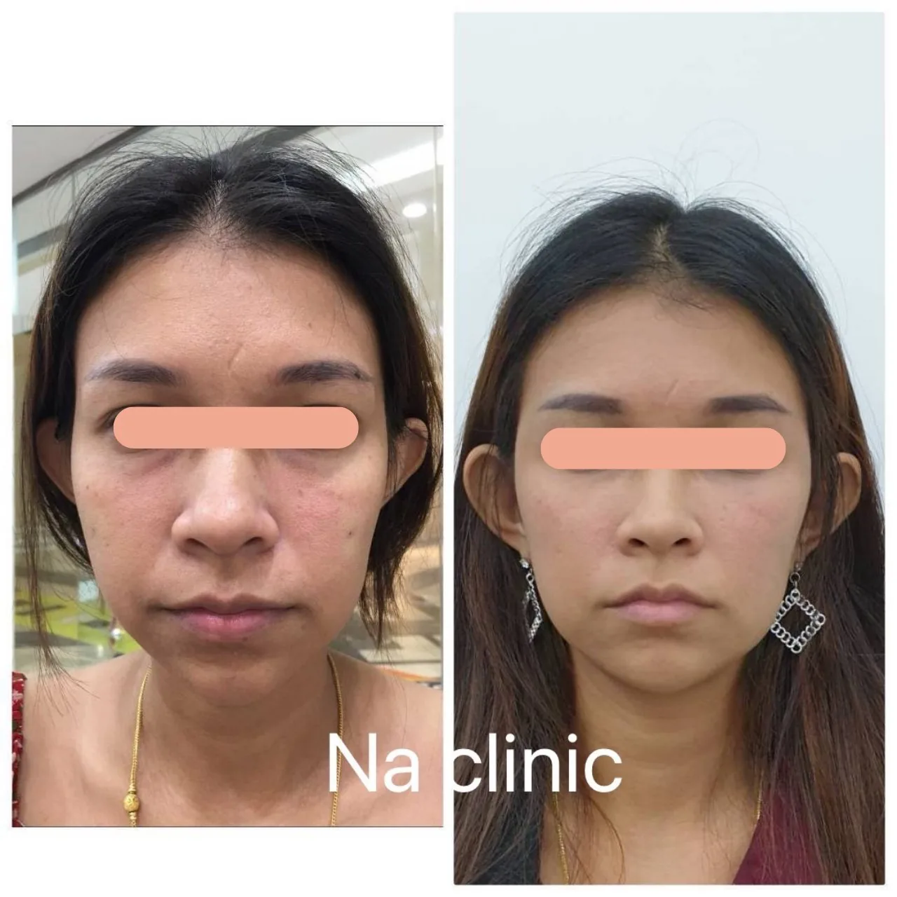 Face Lifting, Filler Program and Metatox Program