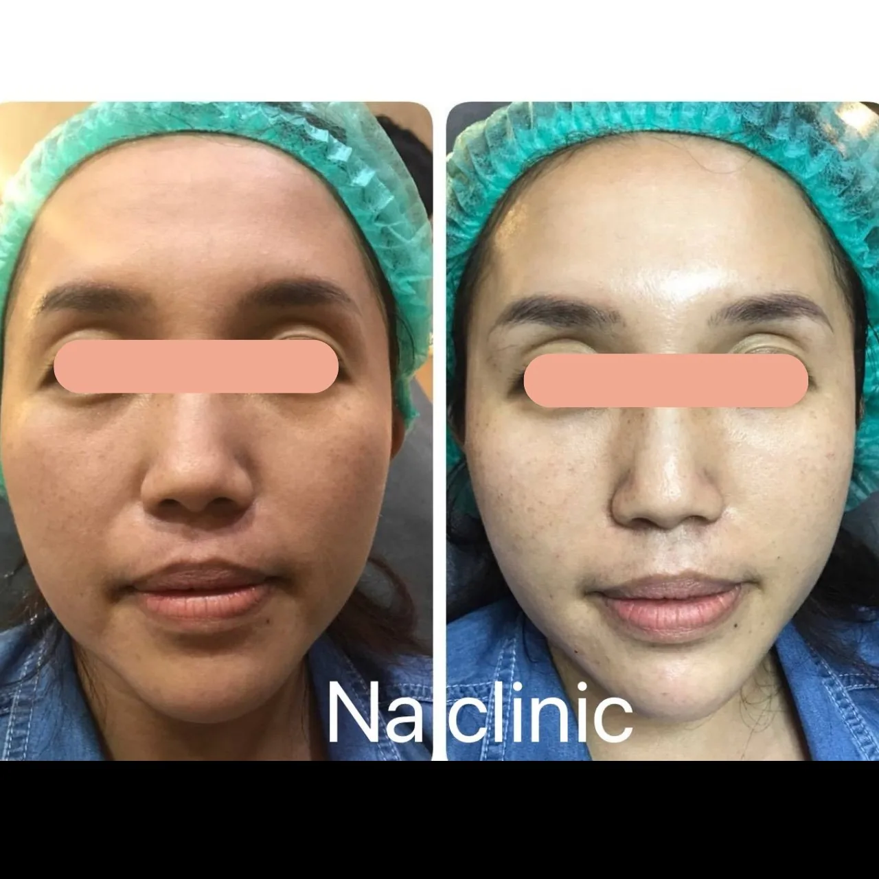Face Lifting, Filler Program