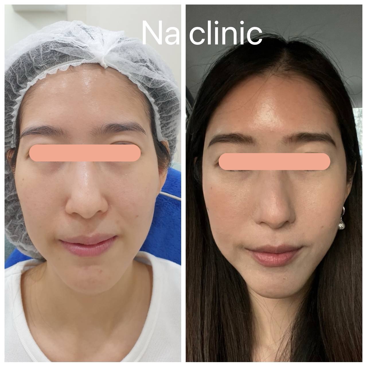 Face Lifting, Filler Temple Area