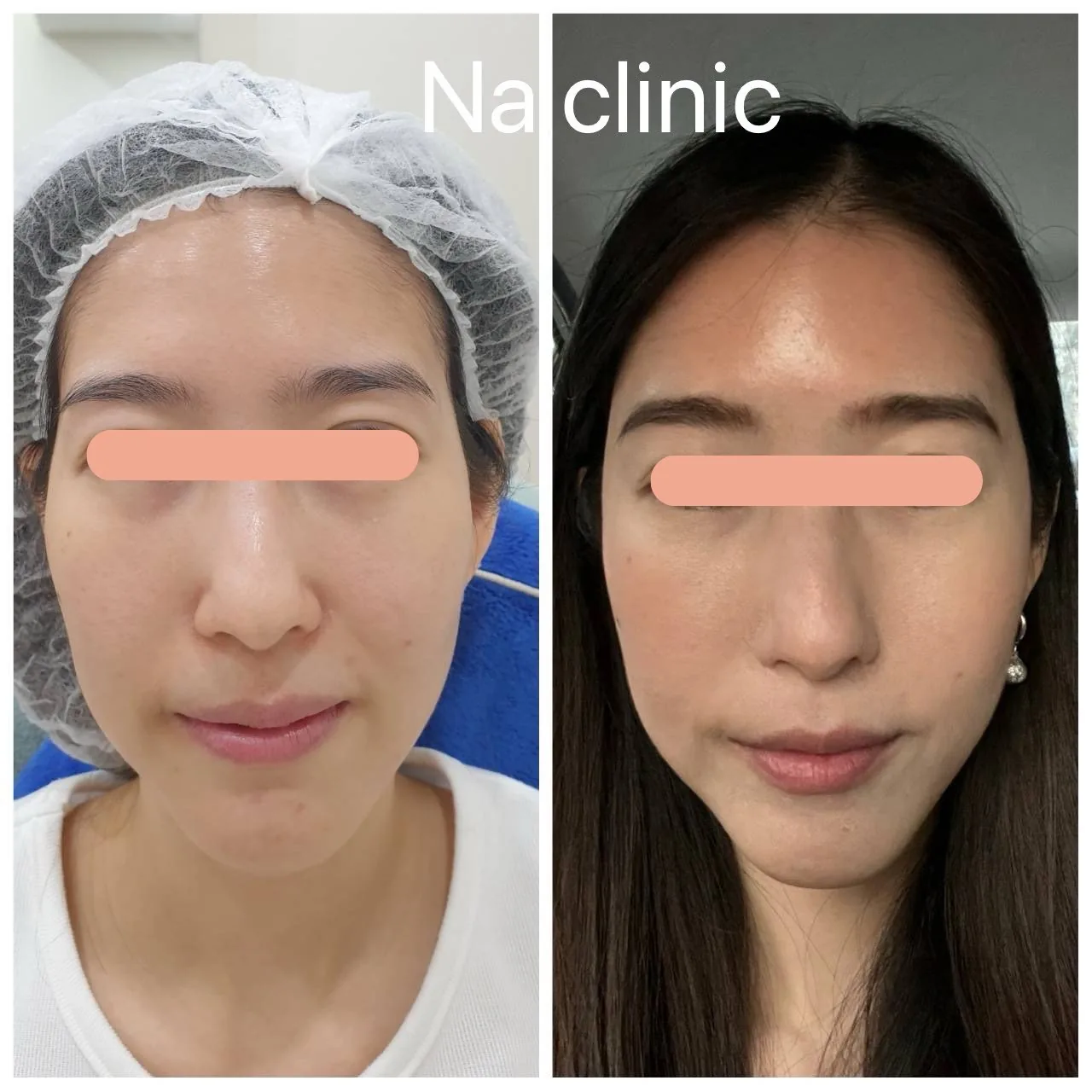 Face Lifting, Filler Program Temple Area