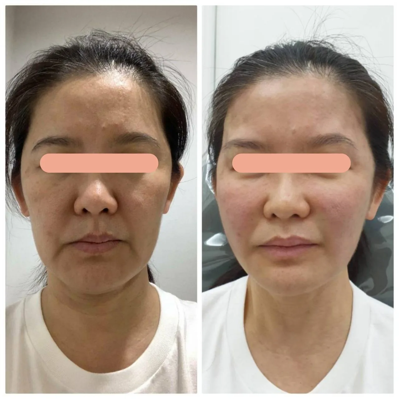 Face Lifting, Thread Lift