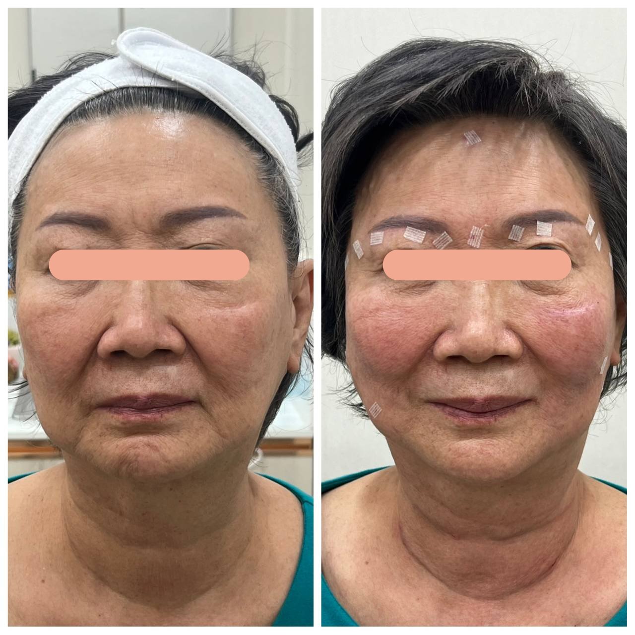 Face Lifting, Thread Lift