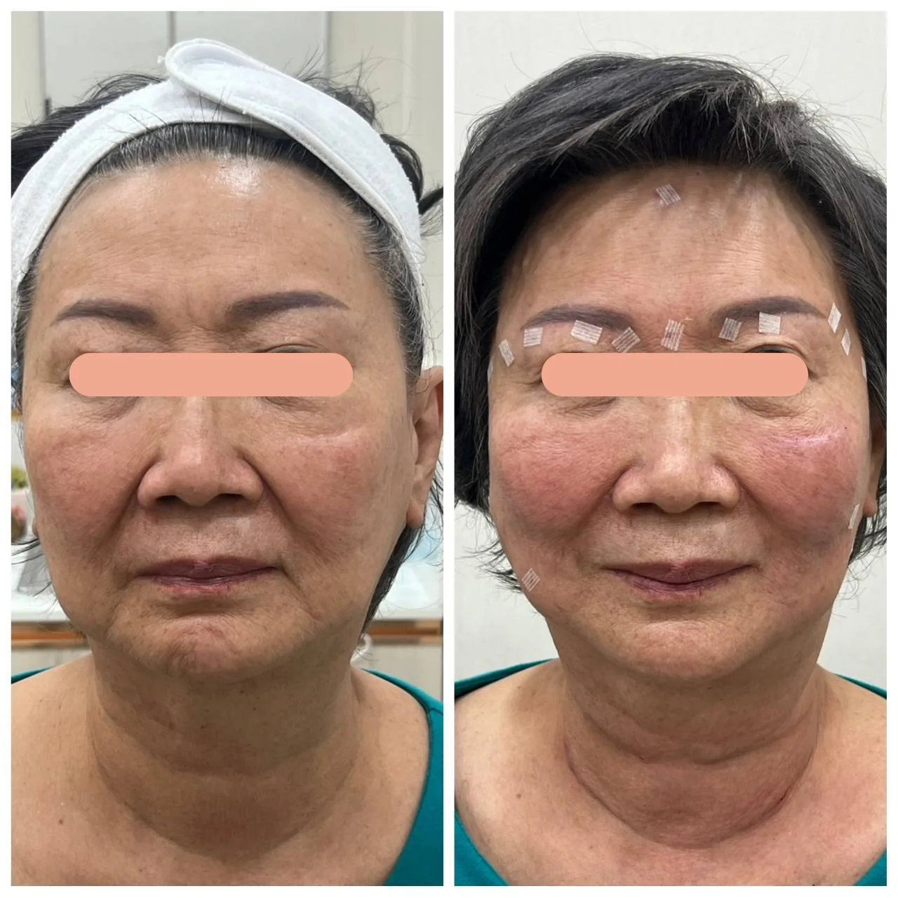 Face Lifting, Thread Lift