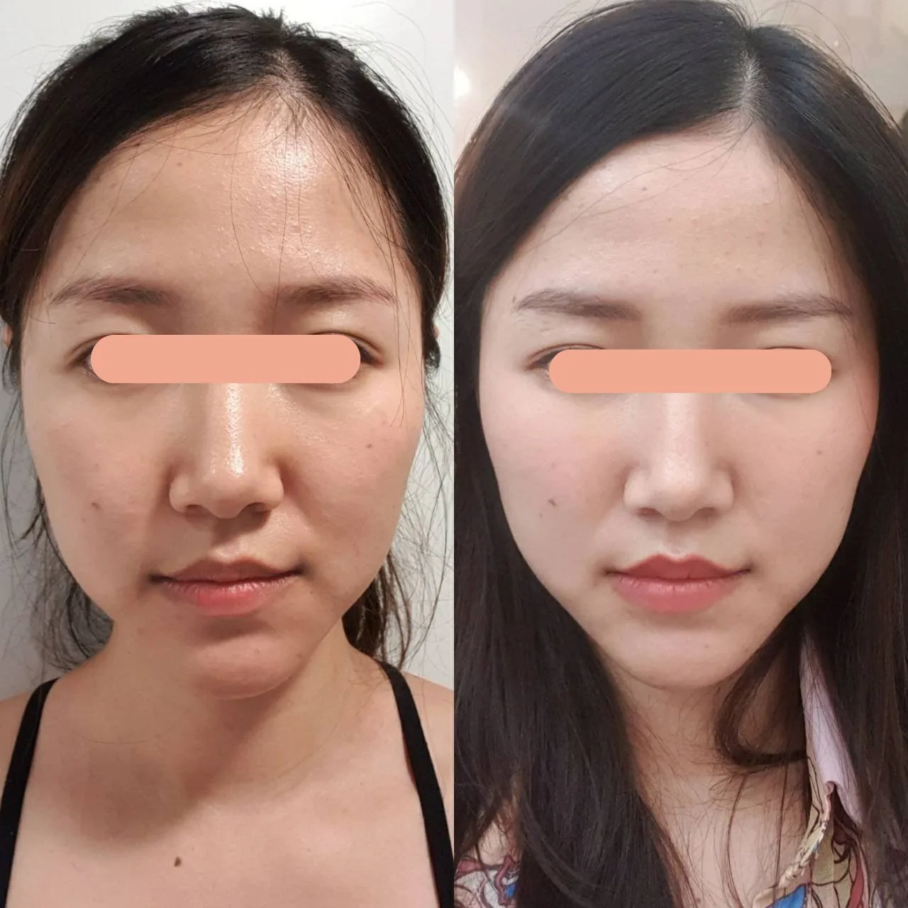 Face Lifting, Thread Lift
