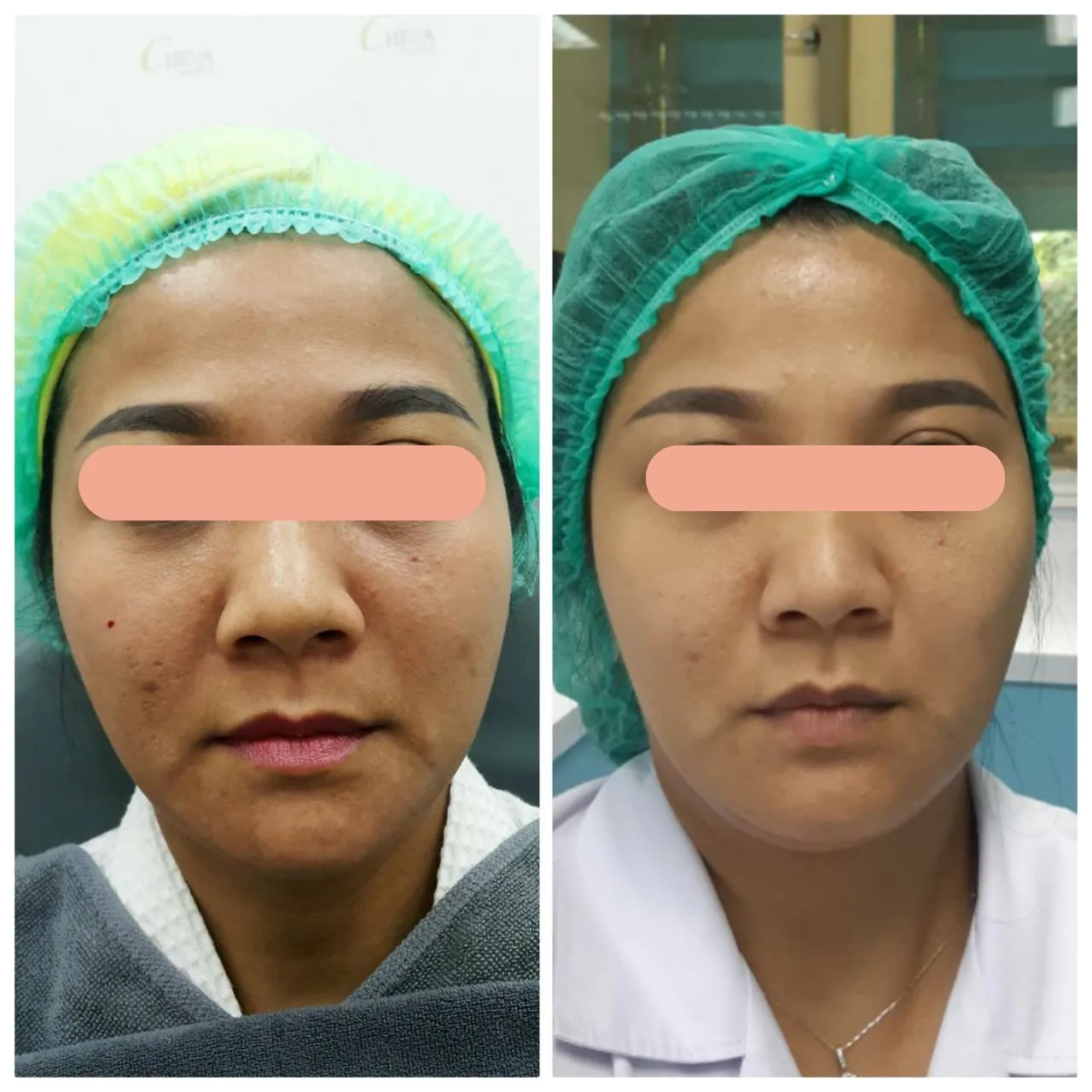 Under Eye Filler Program