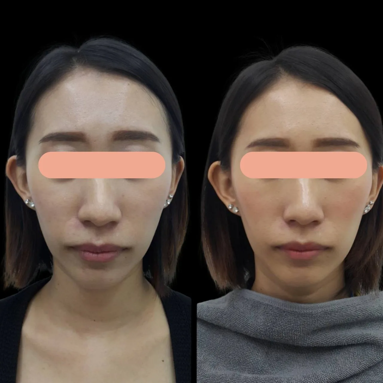 Under Eye Filler Program