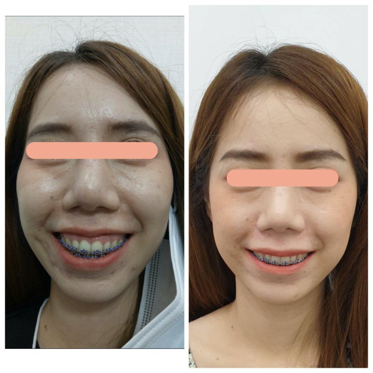 Gummy Smile, Full Smile 2