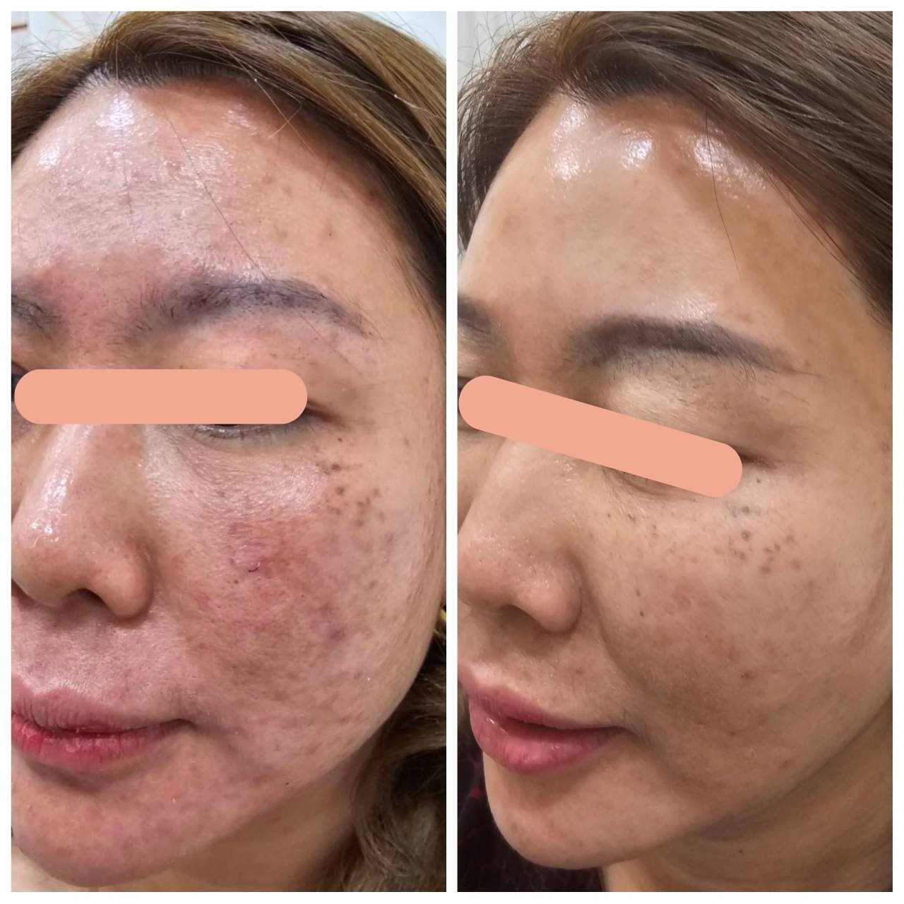 Acne Treatment