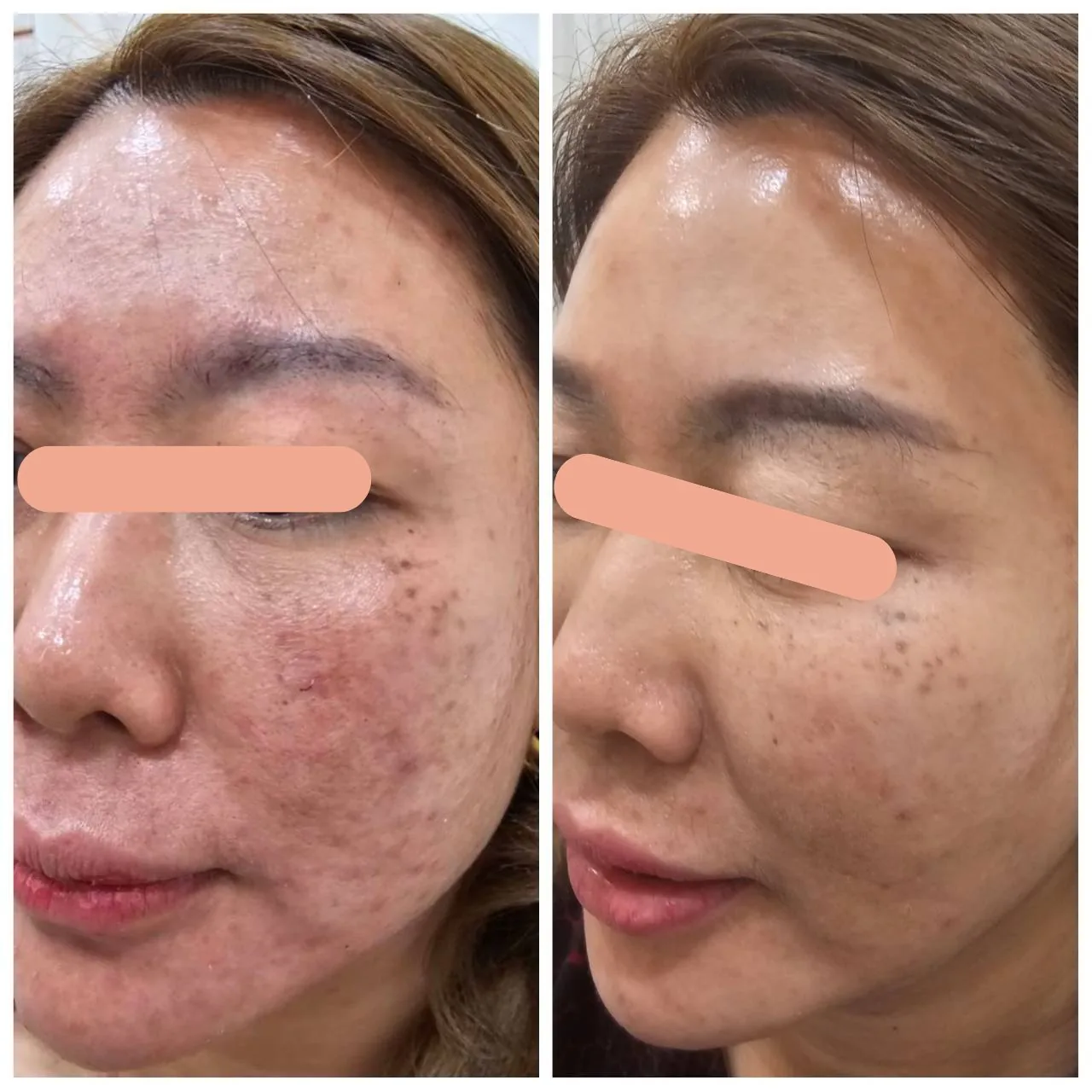 Acne Care Program result