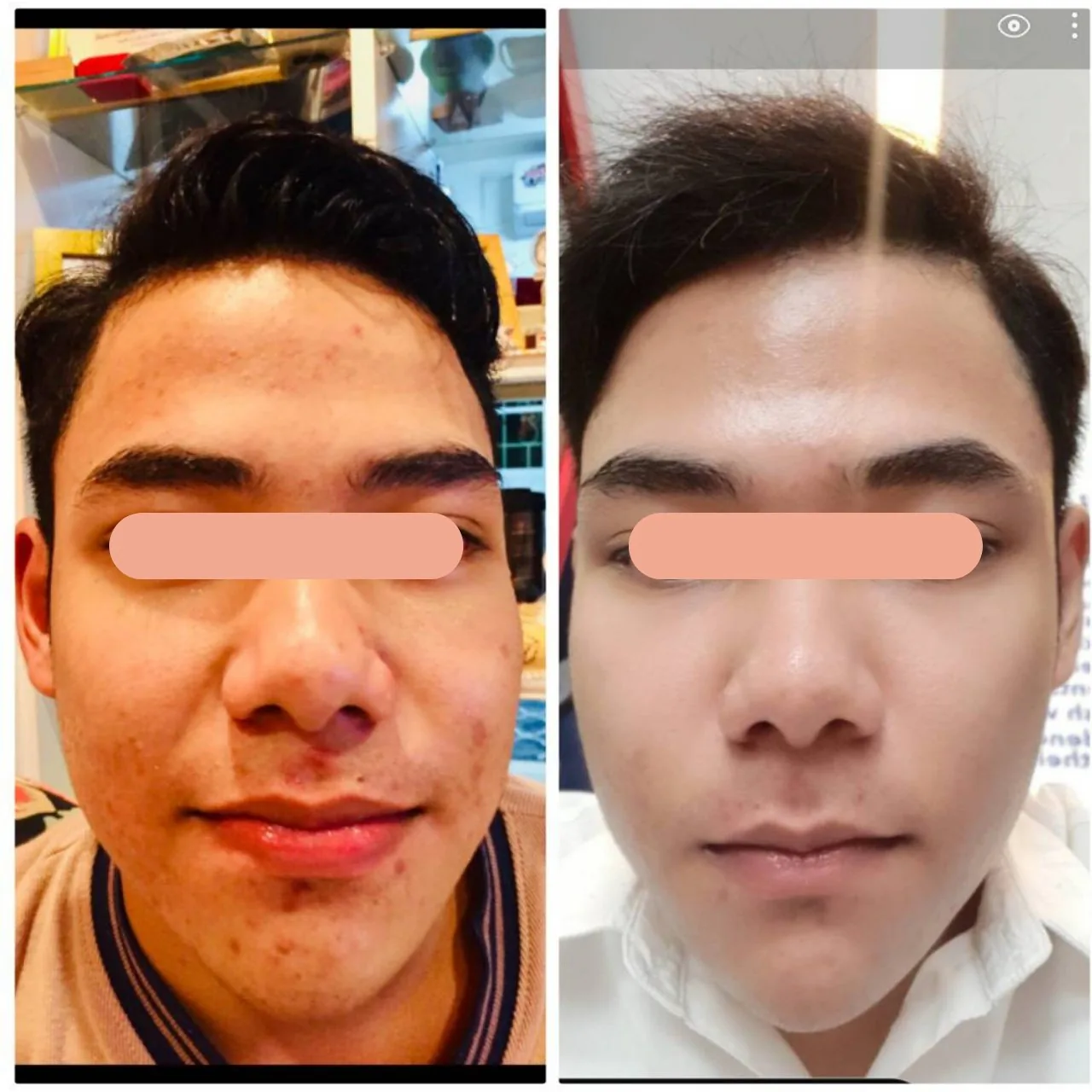 Acne Care Program result