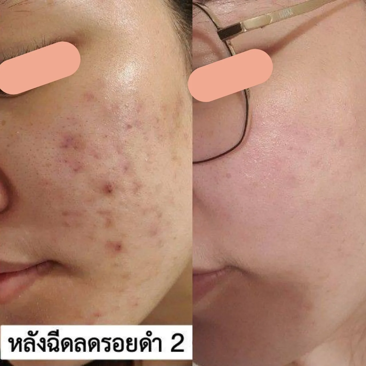 Acne Care Program result