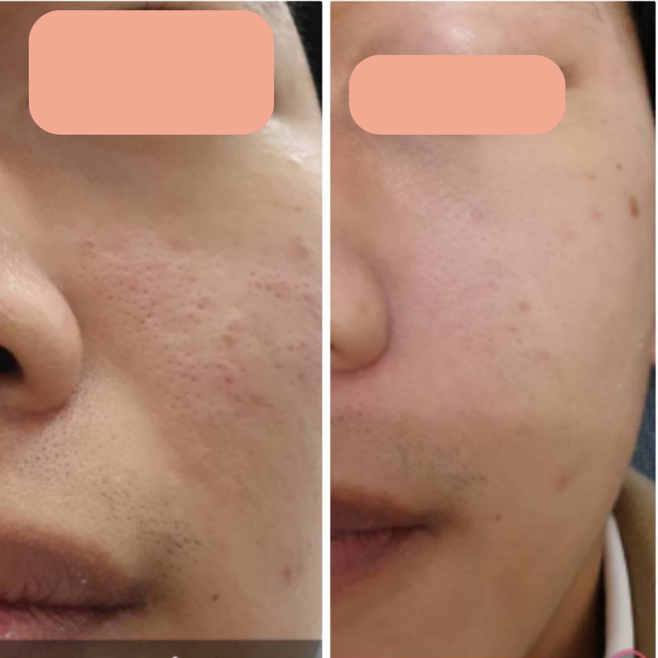 Acne Scar Treatment