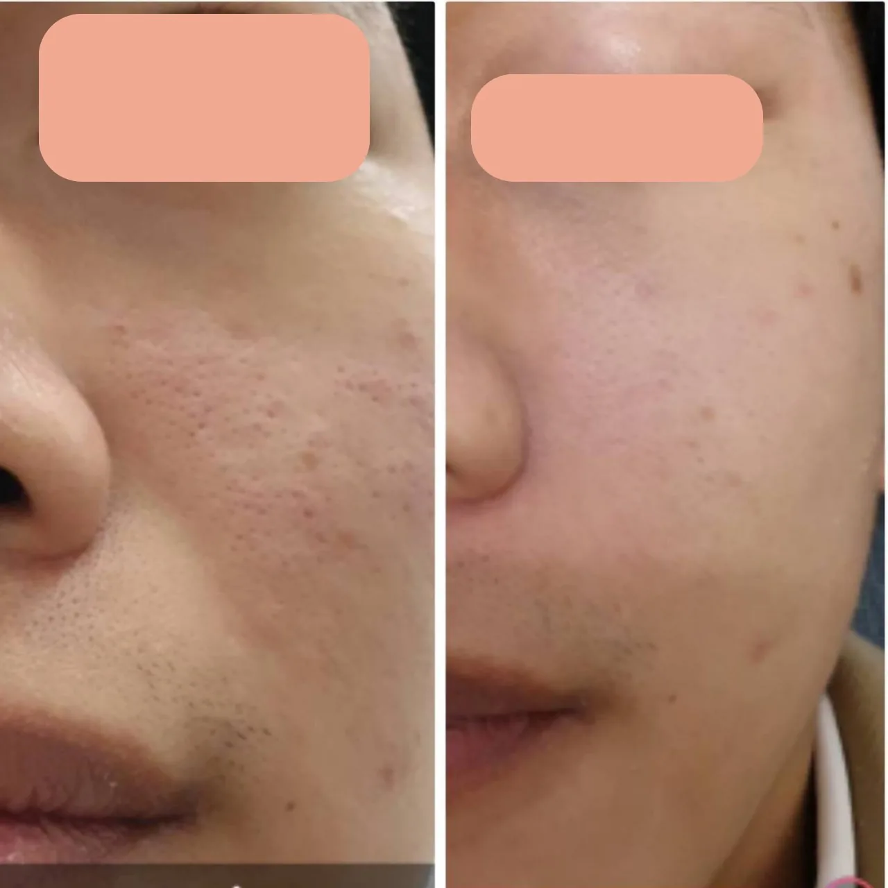 Acne Scar Care Program result