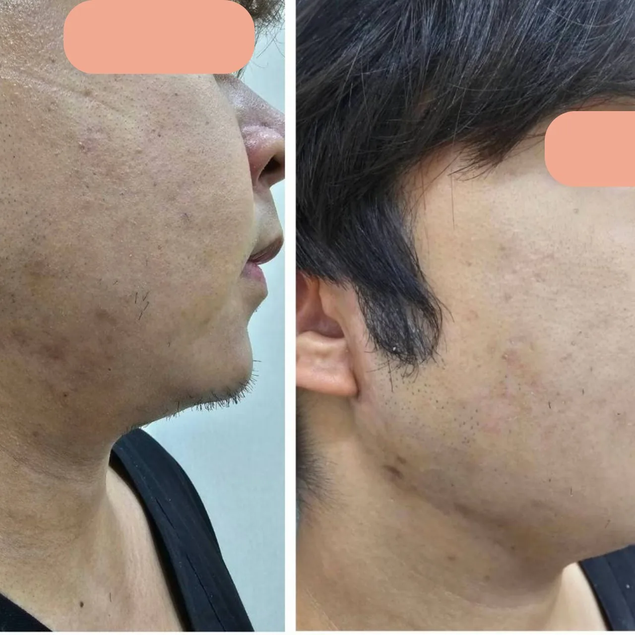 Acne Scar Care Program result