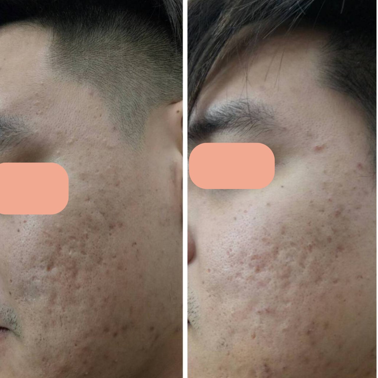 Acne Scar Treatment