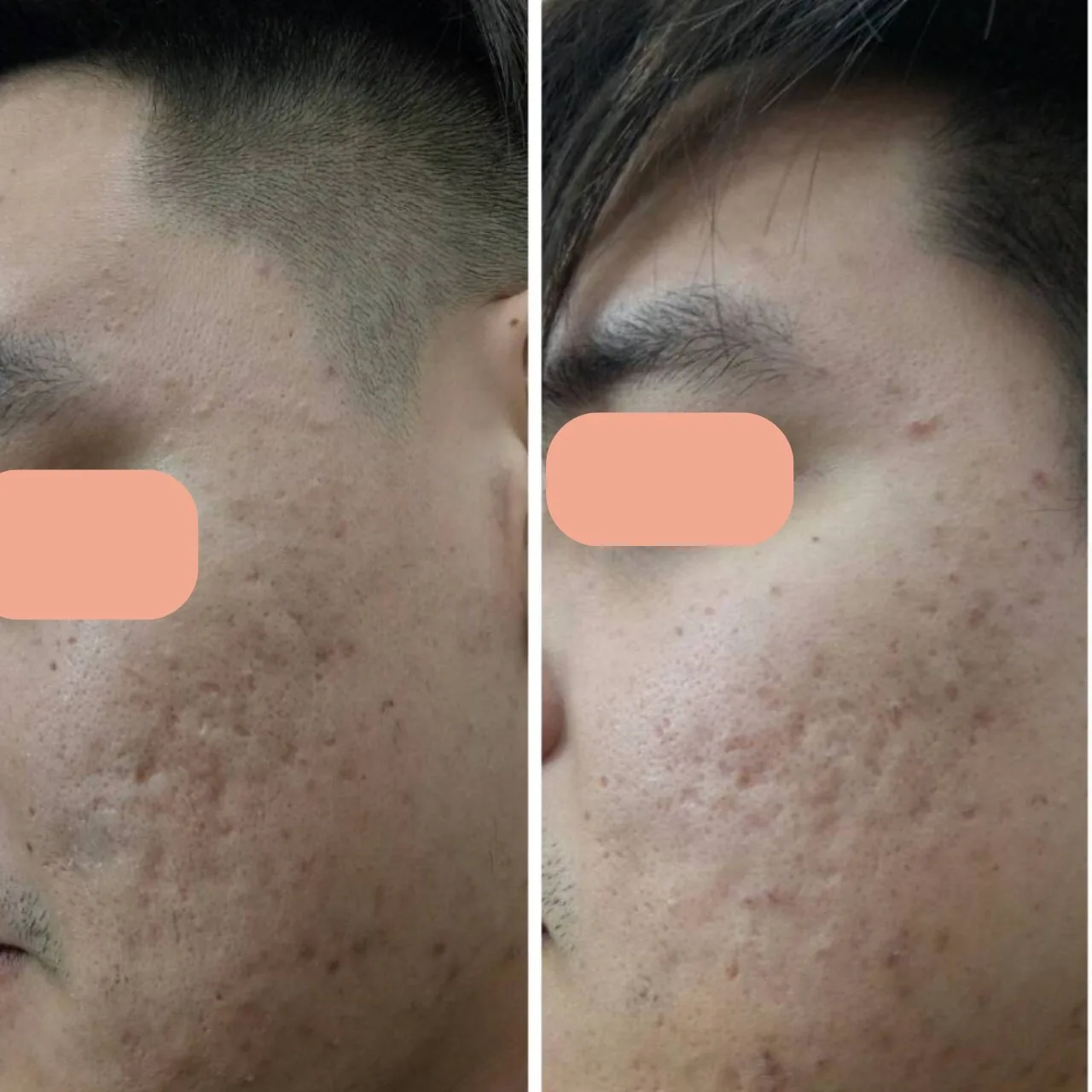 Acne Scar Care Program result