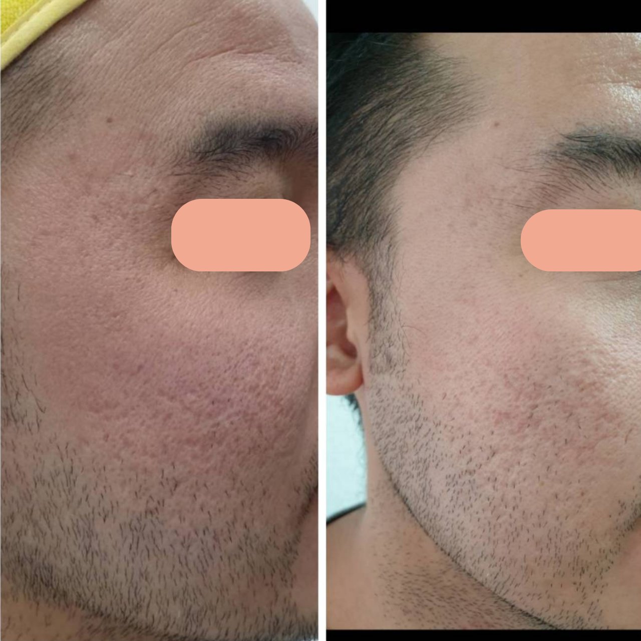 Acne Scar Treatment