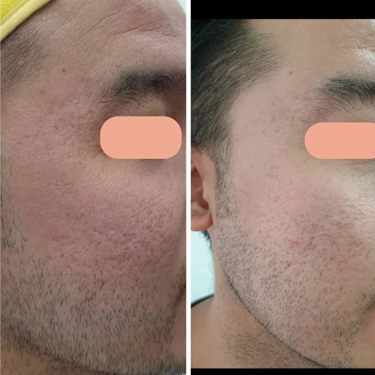 Acne Scar Care Program result