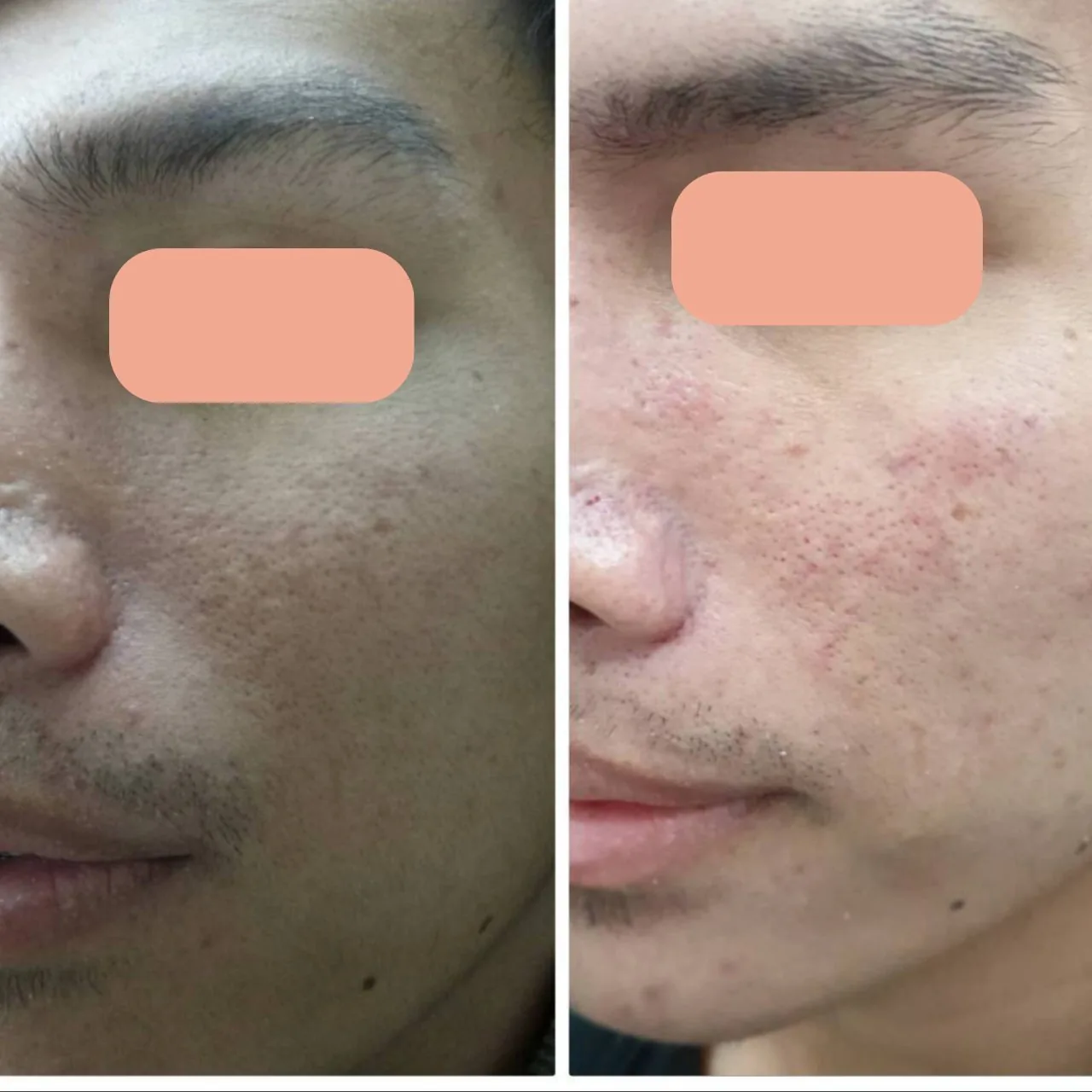 Acne Scar Care Program result