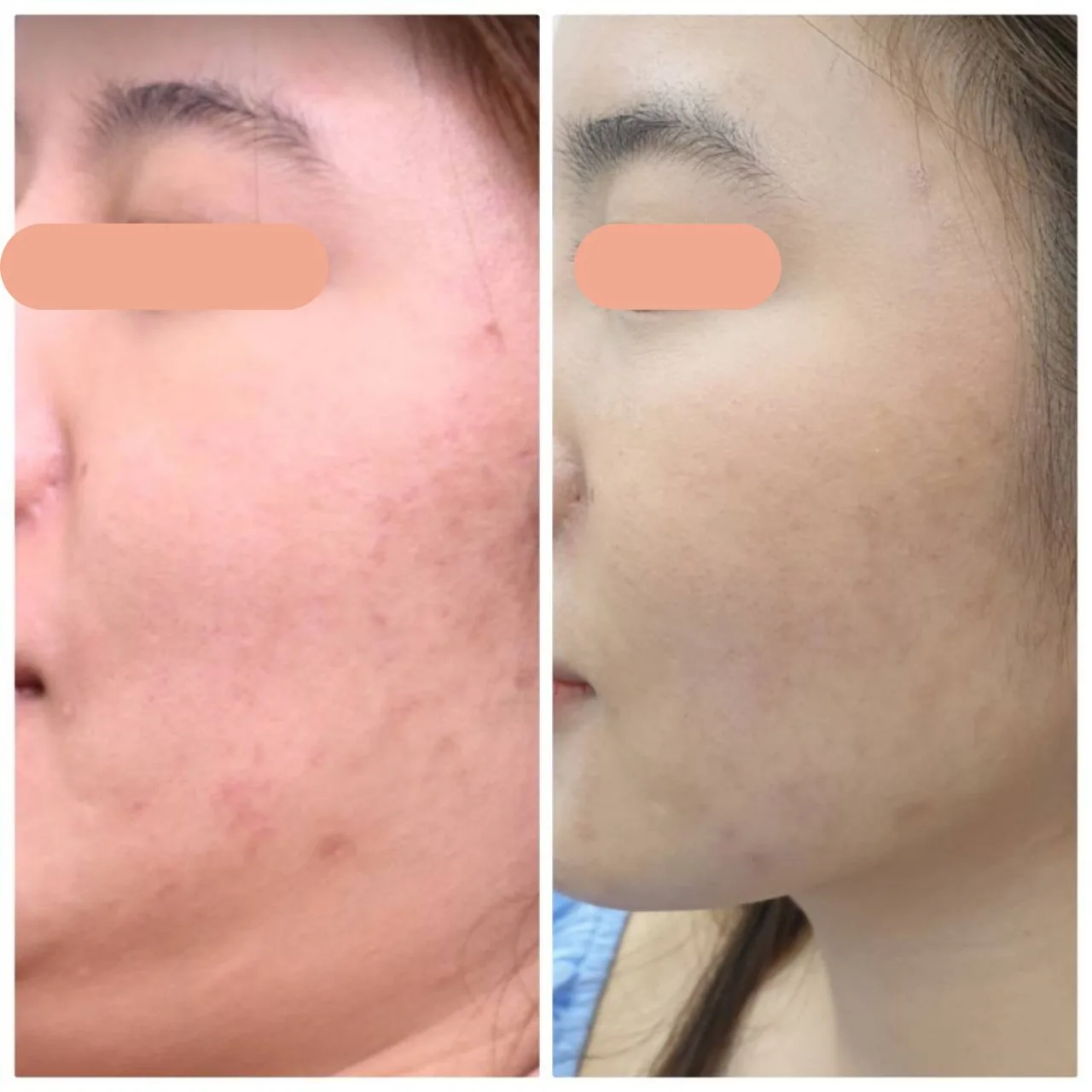 Melasma Program result