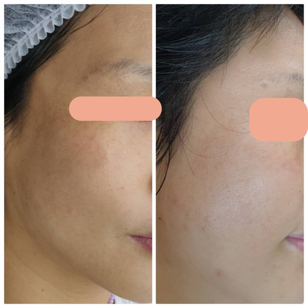 Melasma Treatment