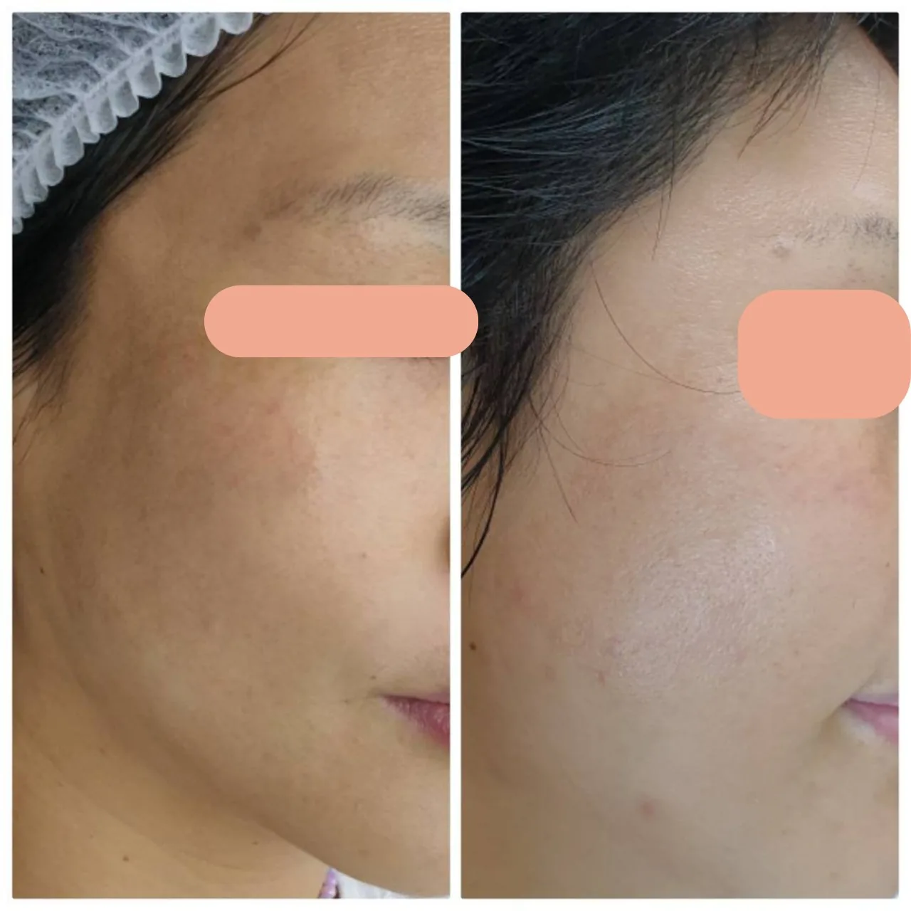 Melasma Program result