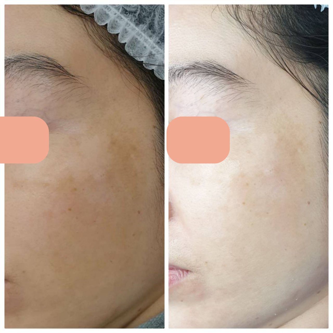 Melasma Treatment