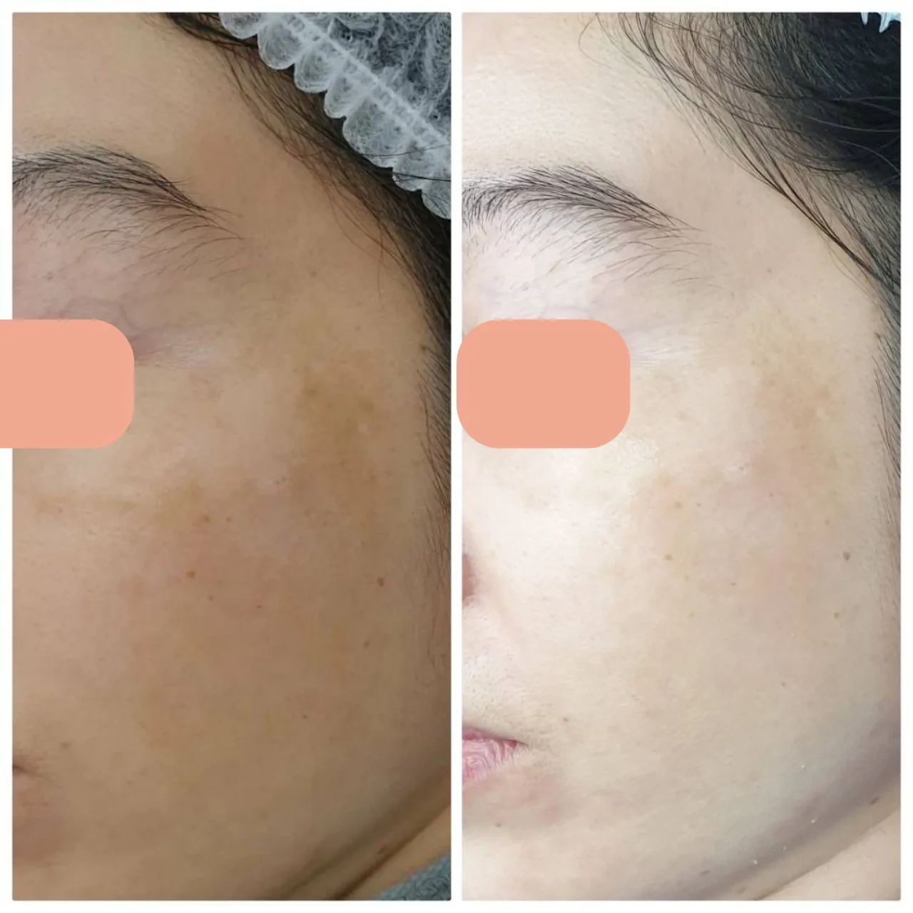 Melasma Program result