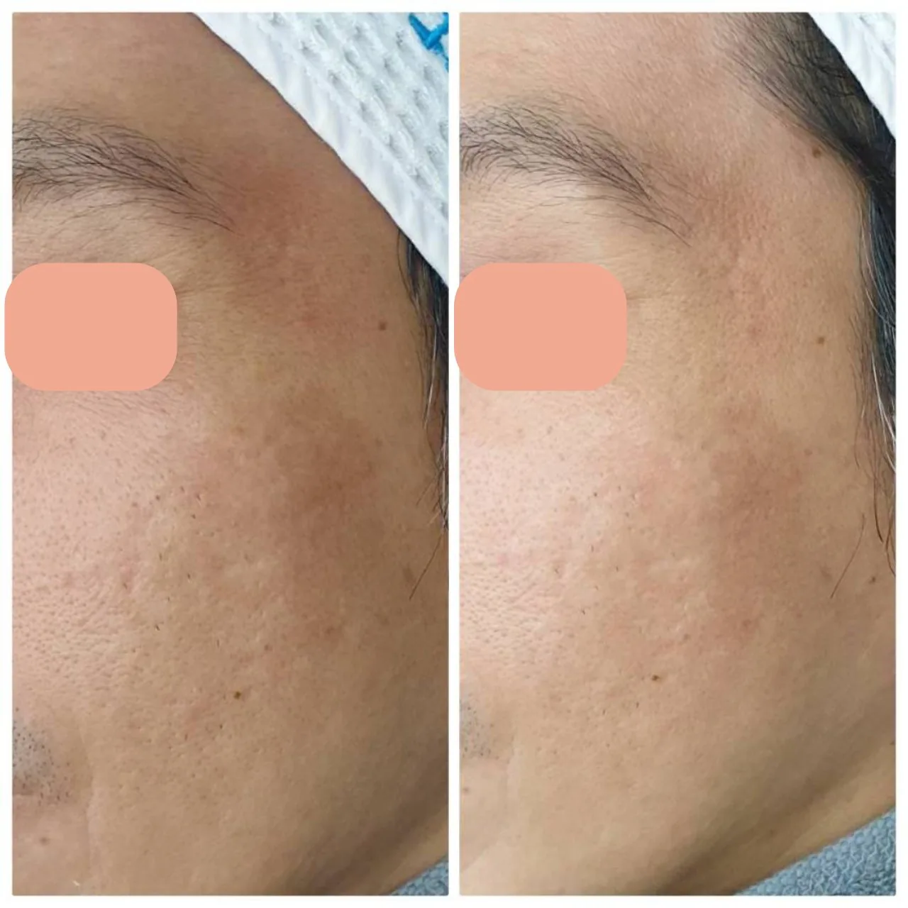 Melasma Program result
