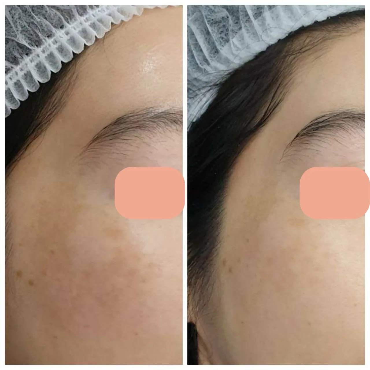 Melasma Program result