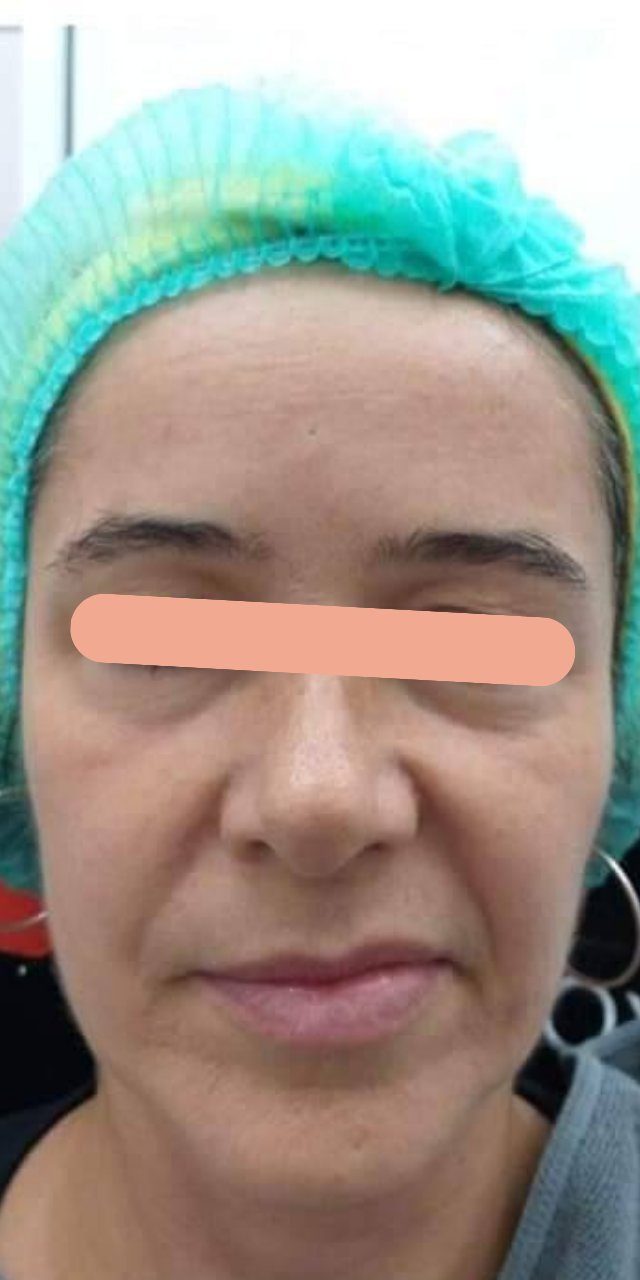 Improved Facial Symmetry & Skin Firmness before