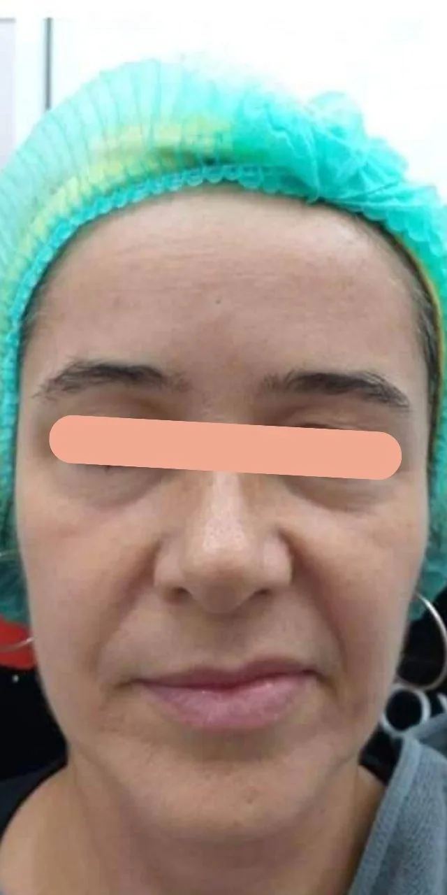 Improved Facial Symmetry & Skin Firmness before