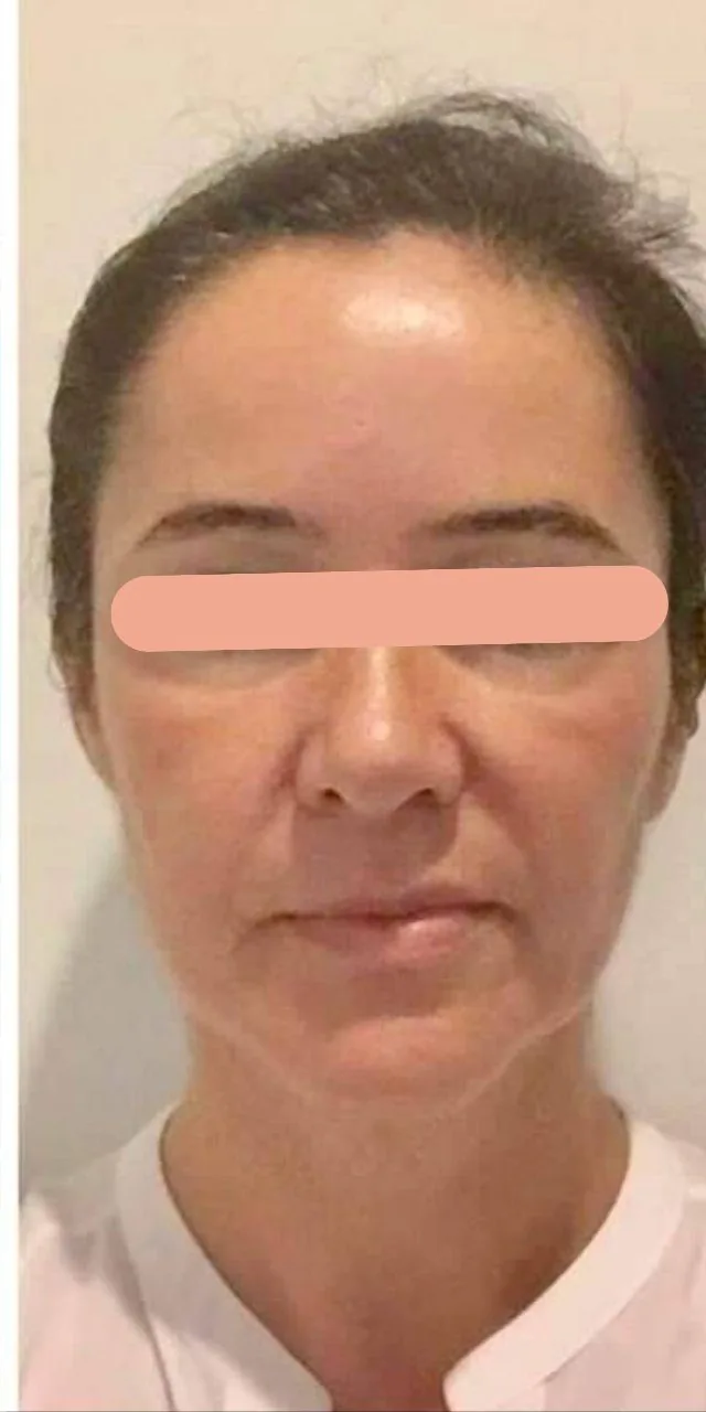Improved Facial Symmetry & Skin Firmness after