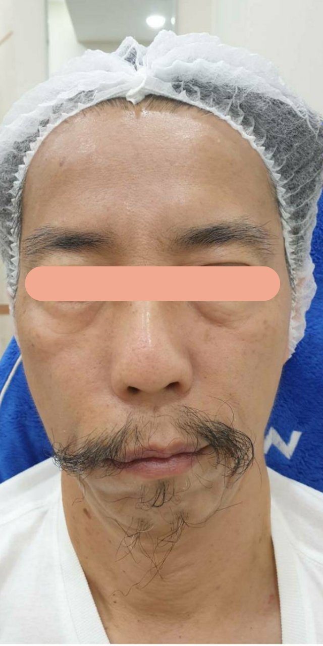 Restored Facial Symmetry & Tightening before