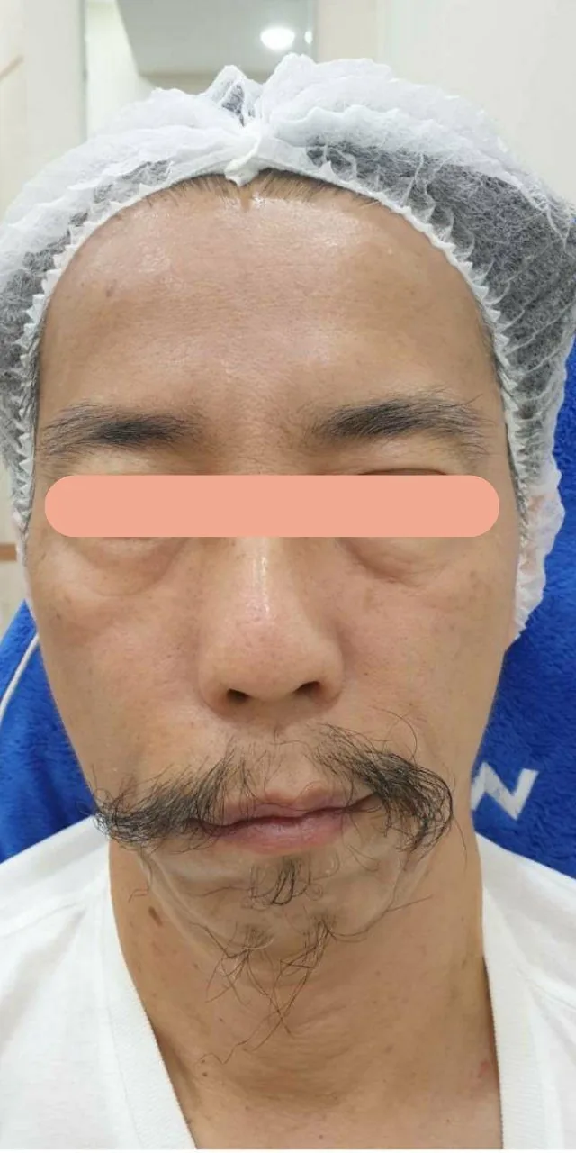 Restored Facial Symmetry & Tightening before