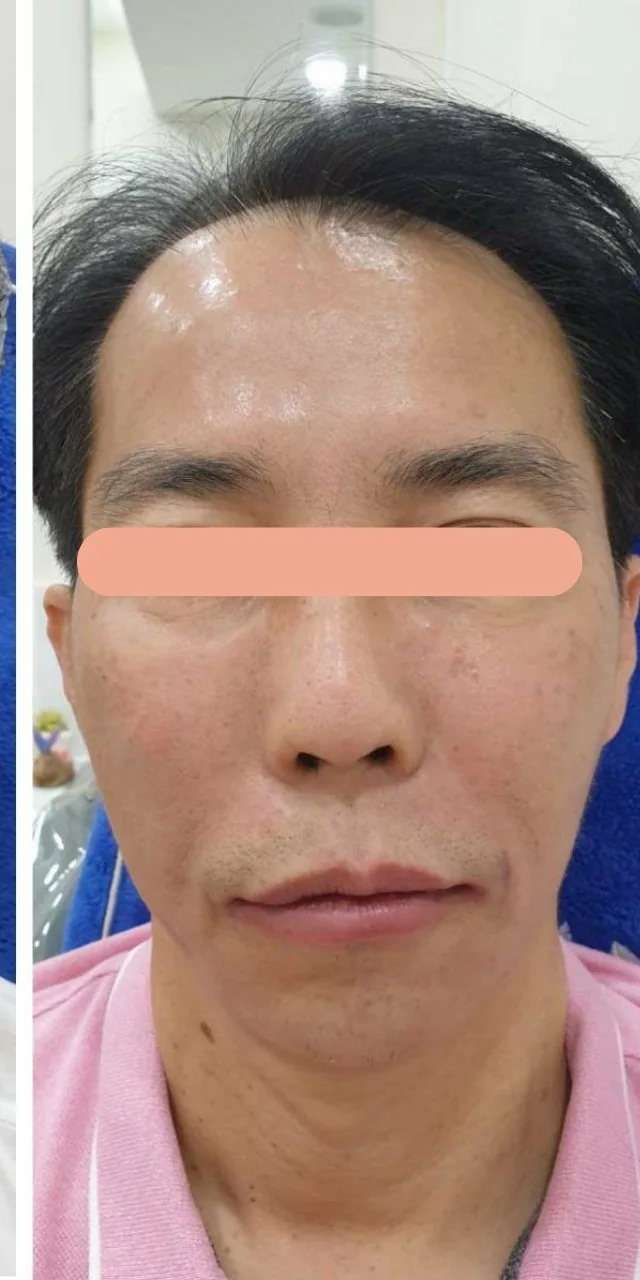 Restored Facial Symmetry & Tightening after