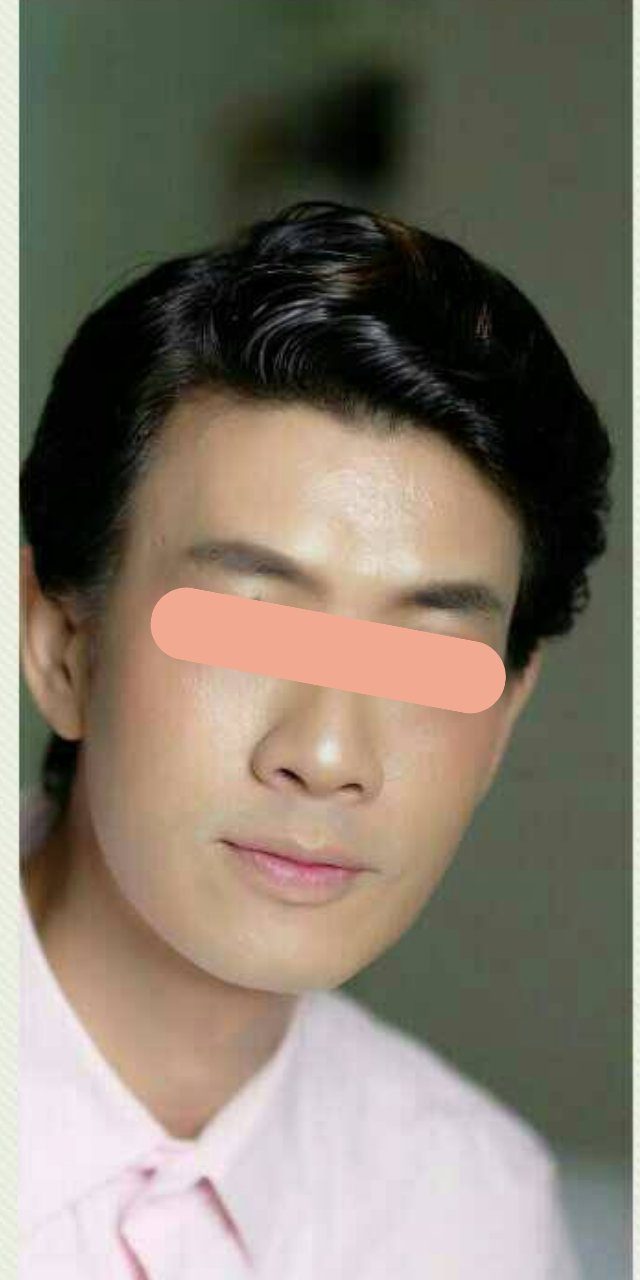 Nose Refinement with Botox after